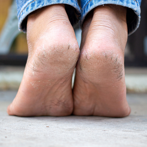 Chăm sóc da chân: Bí quyết làm mềm và dưỡng ẩm tự nhiên cho đôi chân khỏe mạnh